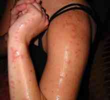 Alergičan na ubode komaraca - Simptomi i liječenje