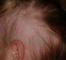 Alopecija kod djece: uzroci i liječenje. Alopecija, a ukupni alopecija kod djece