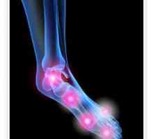 Artritis od stopala zgloba: uzroci, simptomi i liječenje