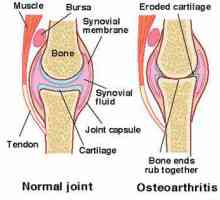 Osteoartritis od zglobovi: liječenje lijekovima i narodnih lijekova