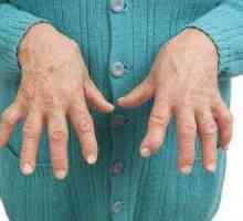 Osteoartritis prstiju: Simptomi i liječenje