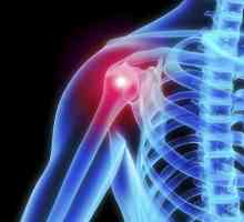 Osteoartritis od ramenog zgloba: Simptomi i liječenje narodnih lijekova, uzroci i metode dijagnoze