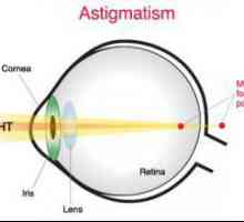 Astigmatičan kontaktne leće: značajke, vrste i primjena tehnologije