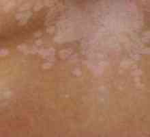 Bijele mrlje na koži nakon opekline: liječenje, slika
