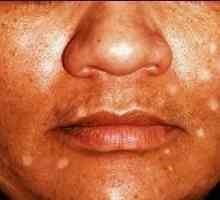 Bijele mrlje na licu može biti znak vitiliga