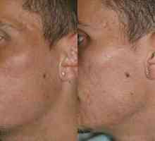Bezbolan i učinkovit lasersko uklanjanje ožiljaka