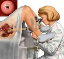 Biopsija cerviksa: što je to i zašto je ovaj postupak se provodi?