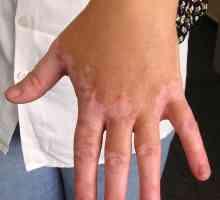 Vitiligo bolesti: uzroci, simptomi i metode liječenja