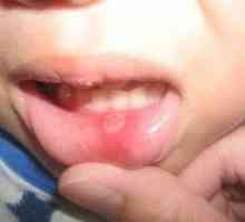 Bolest. Stomatitis u djece: liječenje kod kuće