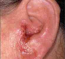 Bolesti uha osoba: Simptomi i liječenje