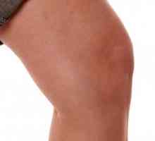 Ono što karakterizira liječenje sinovitis koljena?
