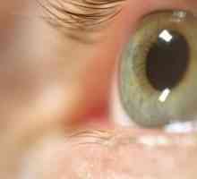 Što ako zagnojiti oči odrasla osoba?