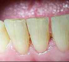 Što ako su pukotine u zubima? Uzroci i liječenje