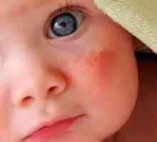 Što učiniti ako dijete ima grube mrlje na tijelu? Što bi to moglo biti
