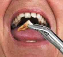 Što učiniti nakon vađenja zuba - kako zaustaviti krvarenje i liječi rane