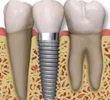To stomatolozi preporučuju, kada postoji potreba za umetanje zube?