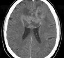 Što je cerebralna astrocitom? Mozak Astrocitom prognoza
