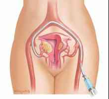 Što su fibroidi maternice? Liječenje i dijagnostika