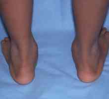 Što je ploskovalgusnye stopala u djece i kako ih liječiti