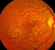 Makularna degeneracija mrežnice: Simptomi i liječenje