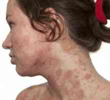 Atipične dermatitis: simptomi, uzroci, liječenje, prehrana