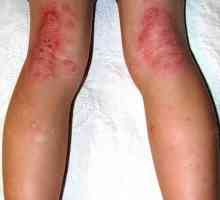 Dermatitis na nogama: uzroci i liječenje