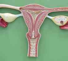 Dijagnoza „endometrioze”: simptomi i liječenje bolesti