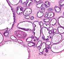Difuzne fibroadenomatosis mliječne žlijezde: uzroci i liječenje