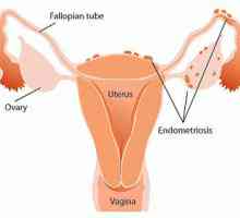 "Djufaston" Endometrioza - recenzije. Učinkovitost „duphaston” cijena