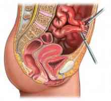 Što se vrši laparoskopiju jajnika?