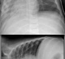 Bilateralna pneumonija: kako se on manifestira, gdje i kako ga liječiti