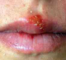 Da li postoji lijek za herpes na usnici koje se mogu dobiti osloboditi od ove bolesti zauvijek?