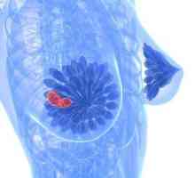 Fibrocističnu bolest dojke: liječenja, simptomi i uzroci