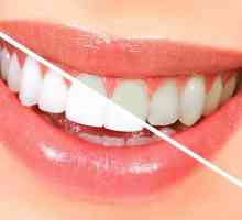 Fluoridizaciji zubi - što je to? Kako je postupak dubokog fluoridation zubi?