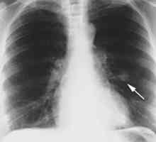 Hamartomskih od pluća: uzroci, simptomi, liječenje