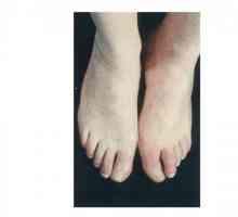 Gangrena na nogama: uzroci, simptomi i liječenje