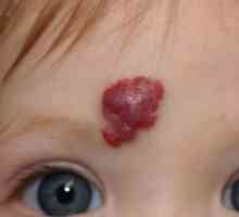 Hemangioma na licu: uzroci i liječenje. Hemangioma na licu odraslih i djece