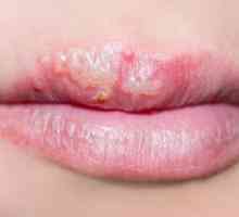 Herpes na usnama: kako izliječiti sve narodnih lijekova? Je li moguće izliječiti hladno čireve na…