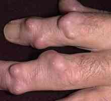 Hygroma na prst: ukloniti ili ne?