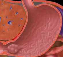 Hiperpla gastritis - što je to?