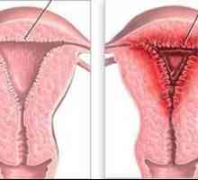 Hiperplazija endometrija: što je to? Uzroci, simptomi i tretman metode