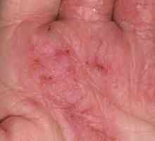 Gljivice na ruku: uzroci, simptomi i liječenje