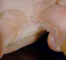 Metode gljiva stopala, simptoma i liječenje