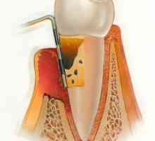 Kronično i akutno parodontitis: simptomi, uzroci i liječenje