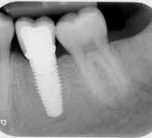 Zubni implantati: kontraindikacije i moguće komplikacije (mišljenja)