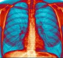 Udisanje bronhitis: ne samo da je moguće, ali je potrebno!