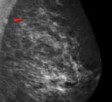 Intramamarnu limfni čvor dojke: što je to, opis, uzroci i karakteristike liječenja