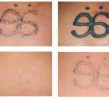 Uzimajući osloboditi od grešaka iz prošlosti: Lasersko uklanjanje tetovaža