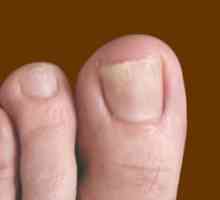 Učinkovito liječenje gljivične nokte na nogama narodnih lijekova