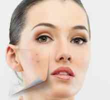 Učinkovit lijek za akne na licu. Kako prevladati prištiće na licu